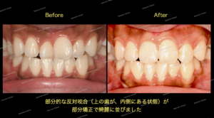 部分矯正による歯のガタガタ、反対咬合（叢生）治療のビフォーアフターBefore After